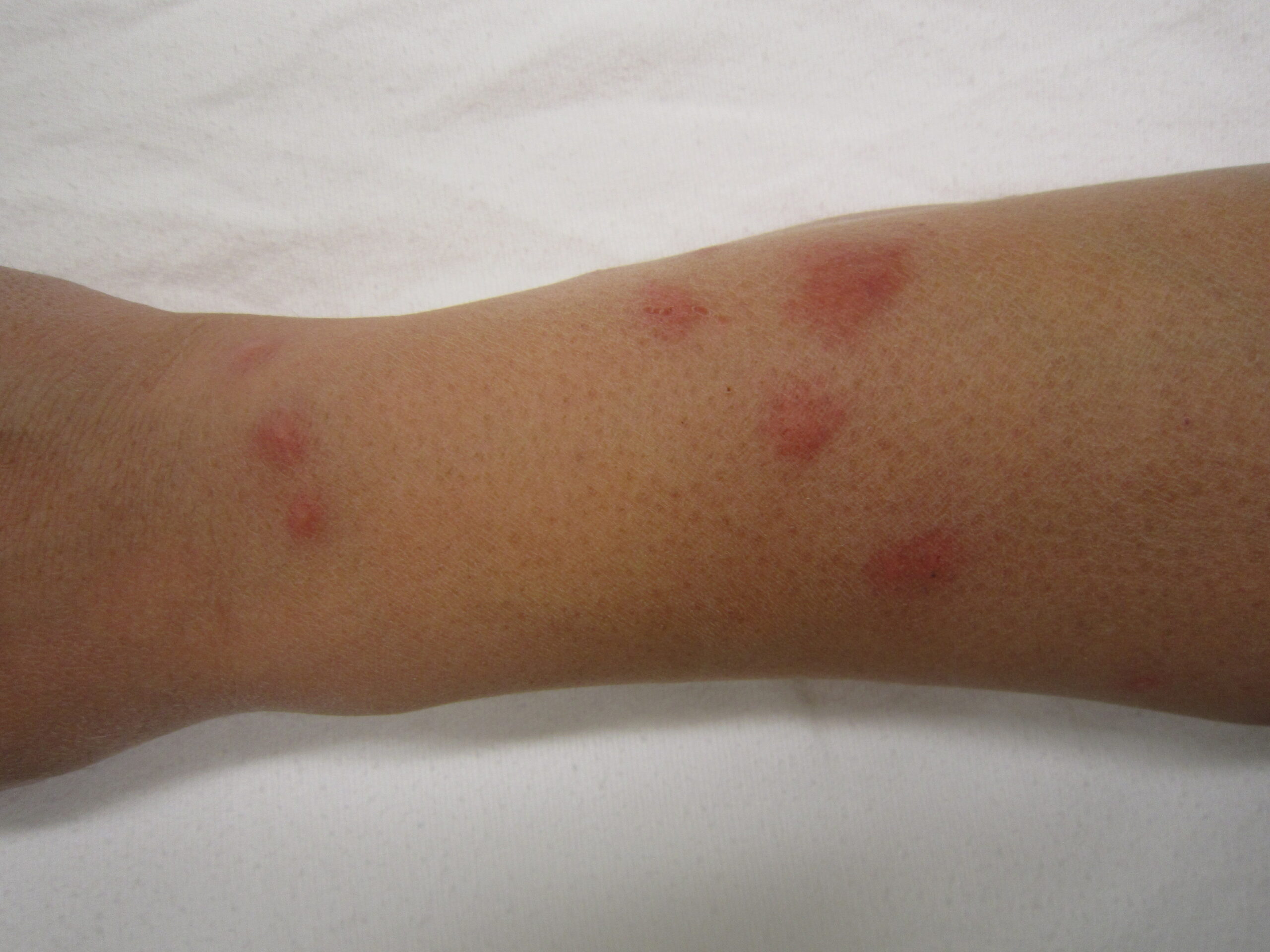 allergic-reaction-to-bed-bug