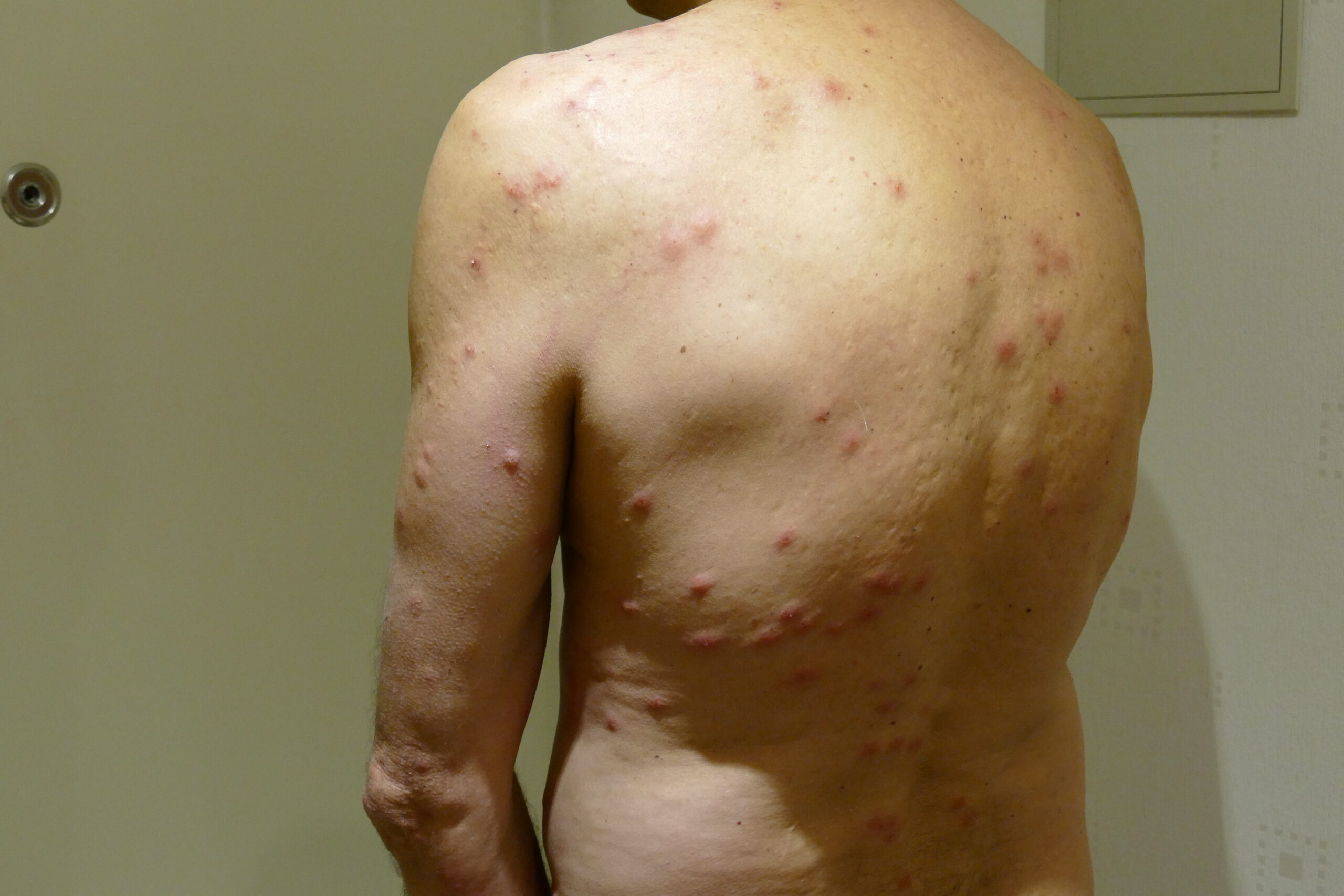 person-with-bed-bug-bites